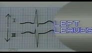 ECG Reading With Axis Deviation