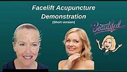 SELF ACUPUNCTURE FACELIFT - An alternative facial rejuvenation procedure.
