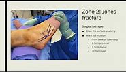 Fracture base of the 5th metatarsal - Session 6 - 10h45 - Paul Ferrao
