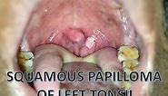 SQUAMOUS PAPILLOMA OF LEFT TONSIL