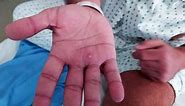 Monkeypox rash and scars: What does monkeypox look like?