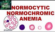 NORMOCYTIC NORMOCHROMIC ANEMIA. Causes, Mechanism & Approach