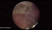 TURBT of bladder mass from anterior bladder wall: Azayem Procedures .. د. خالد أبوالعزائم