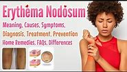 Erythema Nodosum meaning, causes, symptoms, diagnosis, treatment, prevention, home remedies, FAQs