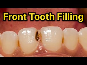 Fixing a cavity on a front tooth
