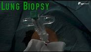 Lung biopsy