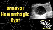 Adnexal Hemorrhagic Cyst || Ultrasound || Case 61