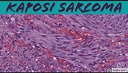 Kaposi Sarcoma: 5-Minute Pathology Pearls