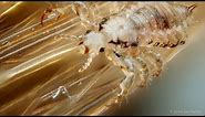 Super Head Lice Spreading Around the World - Behind the News