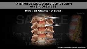 Anterior Cervical Discectomy & Fusion at C3-4, C4-5 & C5-6