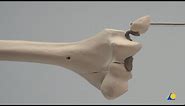 Humerus, Distal—Lateral Condyle and Medial Epicondyle Fractures