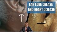 Ear lobe crease as a marker of heart disease - Frank's sign