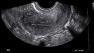 Videoclip demonstrates sweeping through entire uterus so the entire myometrium is seen.