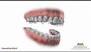 Orthodontic Retainer - Hawley - Instruction and Care
