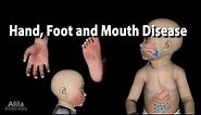 Hand Foot and Mouth Disease, Animation