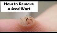 How to Remove a Seed Wart - Treatment for Seed Warts