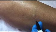 Wart Removal on the Leg | Appearances Aesthetics