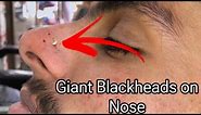 Blackheads on Nose | Giant Blackheads on Nose ​⁠ ​Popping Blackheads