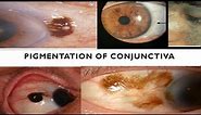 PIGMENTATIONS OF CONJUNCTIVA . Are they cancerous?