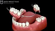 Animated Removable Partial Dentures | Apollo Medical Travel