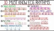 Most Common ECG Patterns You Should Know