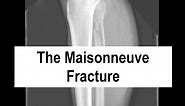 The Maisonneuve Fracture