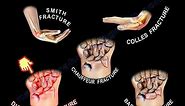wrist fractures, symptoms, examination, diagnosis and treatment.