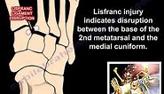 Lisfranc Injury - Everything You Need To Know - Dr. Nabil Ebraheim