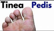 Tinea pedis symptoms and treatment | Toe fungus infection | athletes foot