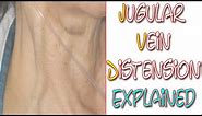 What Is Jugular Vein Distention | Something In About 5 Minutes | Medic Materials
