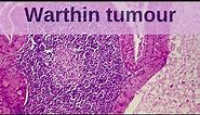 Warthin Tumour - Pathology mini tutorial