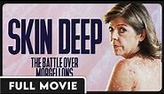 Skin Deep: The Battle Over Morgellons FULL MOVIE - Documentary, Independent