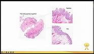Understanding Carcinoma in Situ