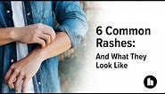 6 Common Rashes: And What They Look Like | Healthline