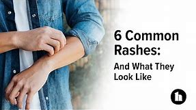 6 Common Rashes: And What They Look Like | Healthline