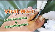 Treatment of Viral Wart on Foot (Big Toe) by Electrofulguration | Electric Cautery | HPV
