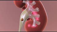 Observation: Non-surgical Approach to Kidney Stones