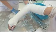 Betty in Double Long Arm Plaster Casts! 🚑