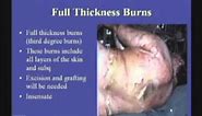 Initial Management of Burns - B. Potenza, MD