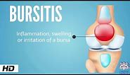 Bursitis, Causes, Signs and Symptoms, Diagnosis and Treatment.