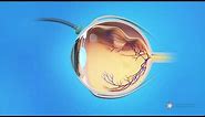 Vitrectomy Surgery for Detached Retina