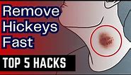 How to Remove HICKEYS Fast - 5 Proven Methods That Work - Get Rid of Hickey Quickly