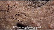 Molluscum contagiosum vs HPV warts on same patient combination infection