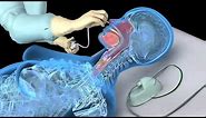 Nasotracheal suctioning (NTS) - 3D animation