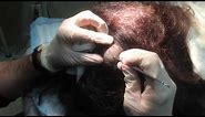 Pilar Cyst Removal on the Scalp