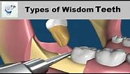 Types of Wisdom Teeth Removal