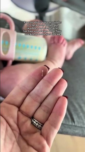 Hair tourniquet in babies? How to safely remove a baby hair tourniquet using Nair #hairtourniquet
