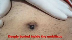 Clean Your Navel Belly (Umbilicus) Properly Or You may Face this In Your Belly Button