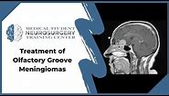 Treatment of Olfactory Groove Meningiomas