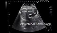 Uterine Polyp with Fibroid on Ultrasound.